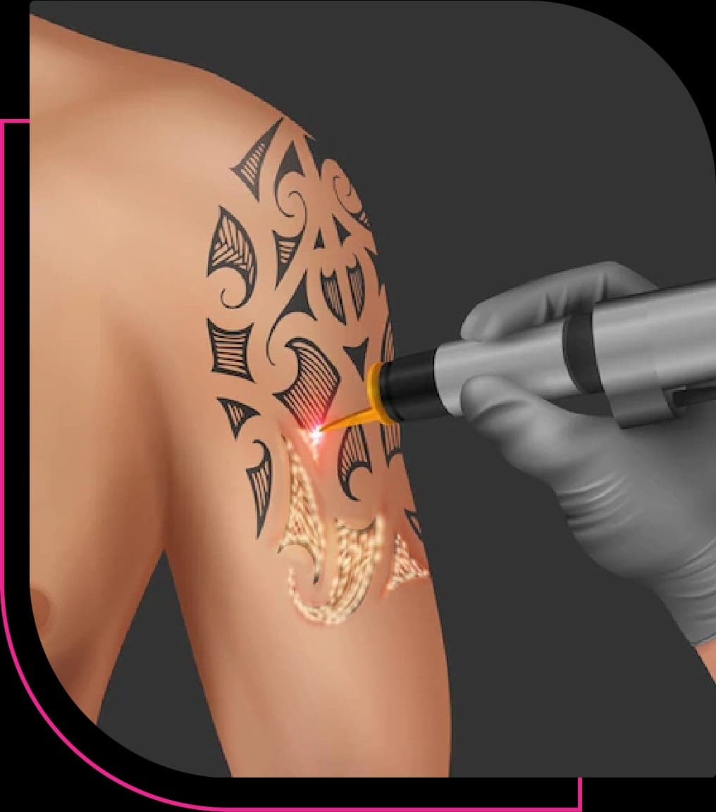 Tattoo Removal (Lazer)