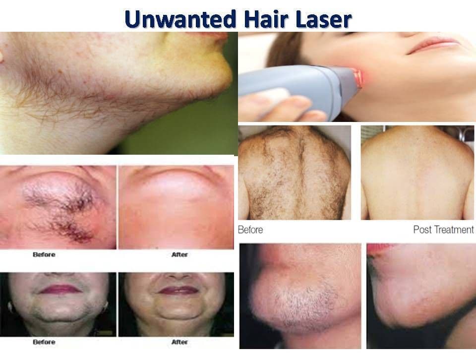 Permanent Hair Removal Treatment