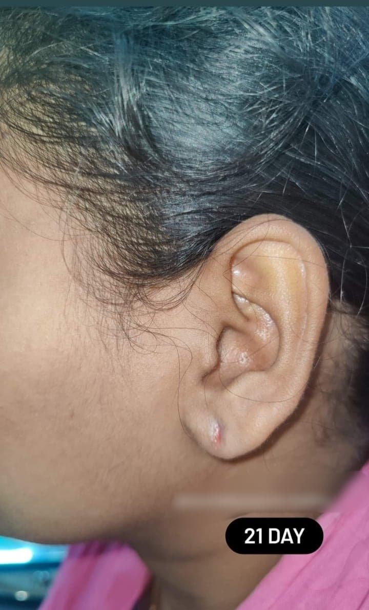 Earlobe Treatment