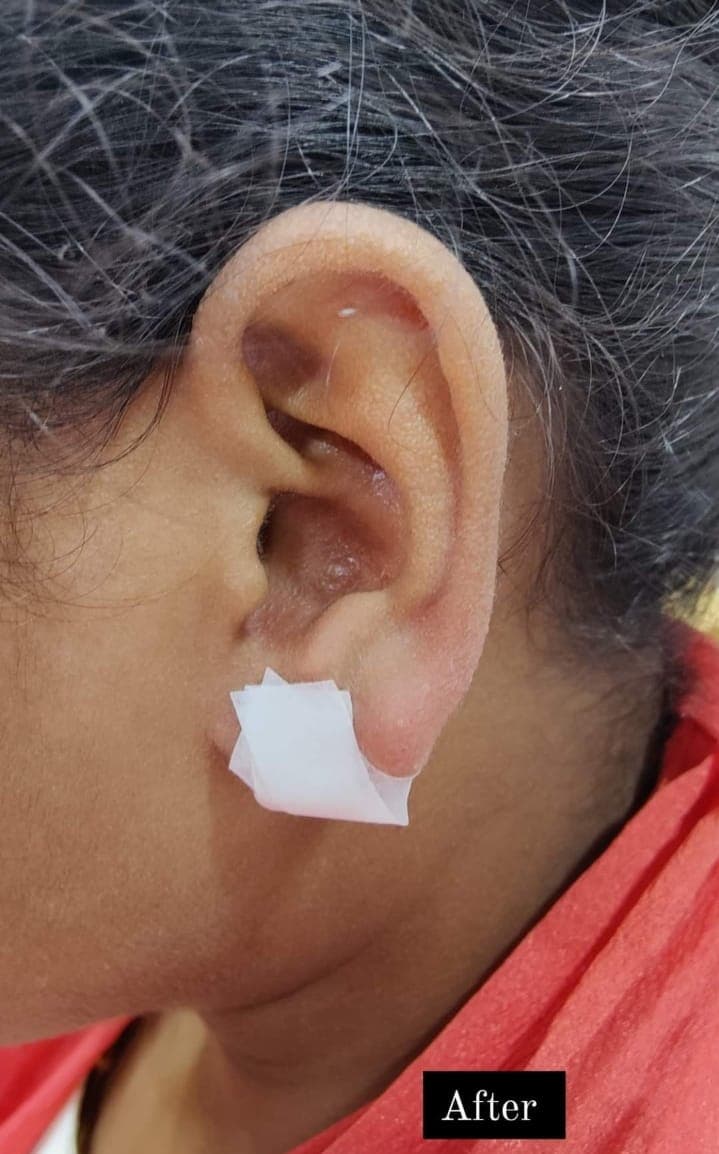 Earlobe Treatment