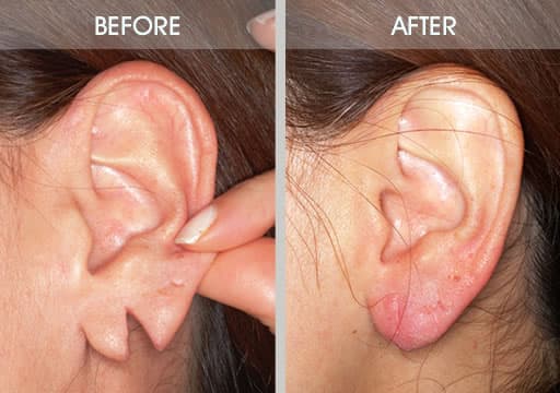 Earlobe Treatment