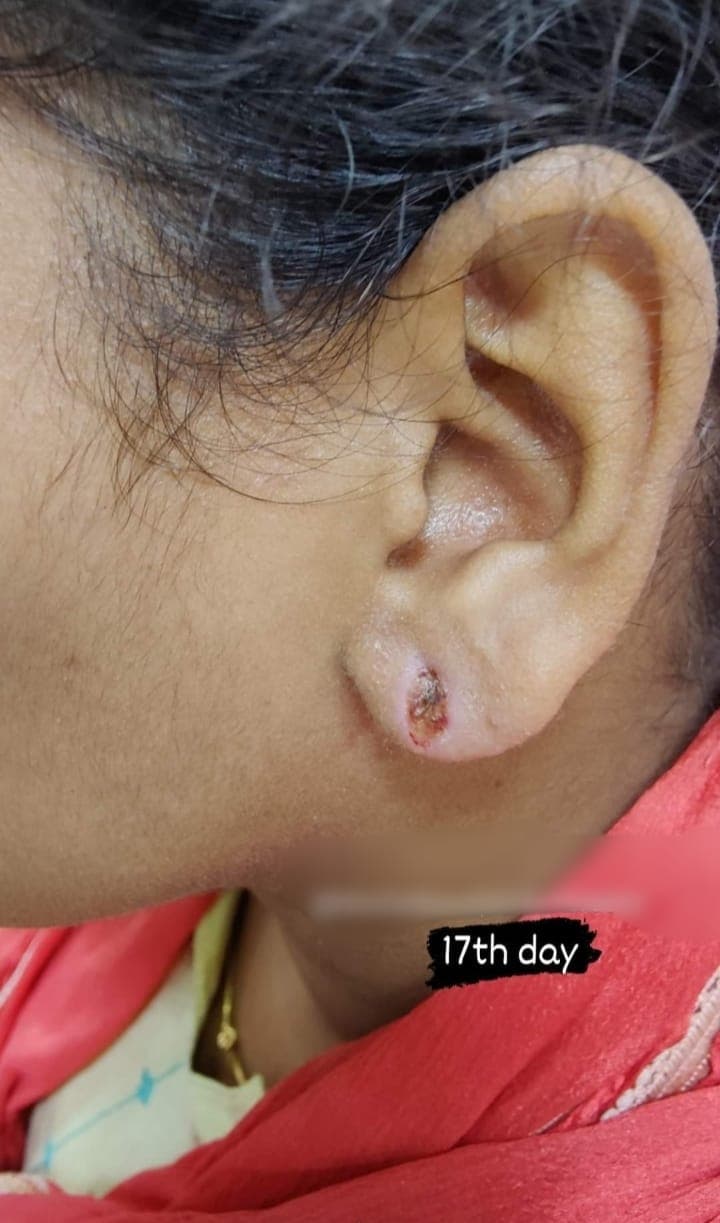 Earlobe Treatment