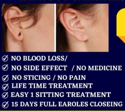 Earlobe Treatment