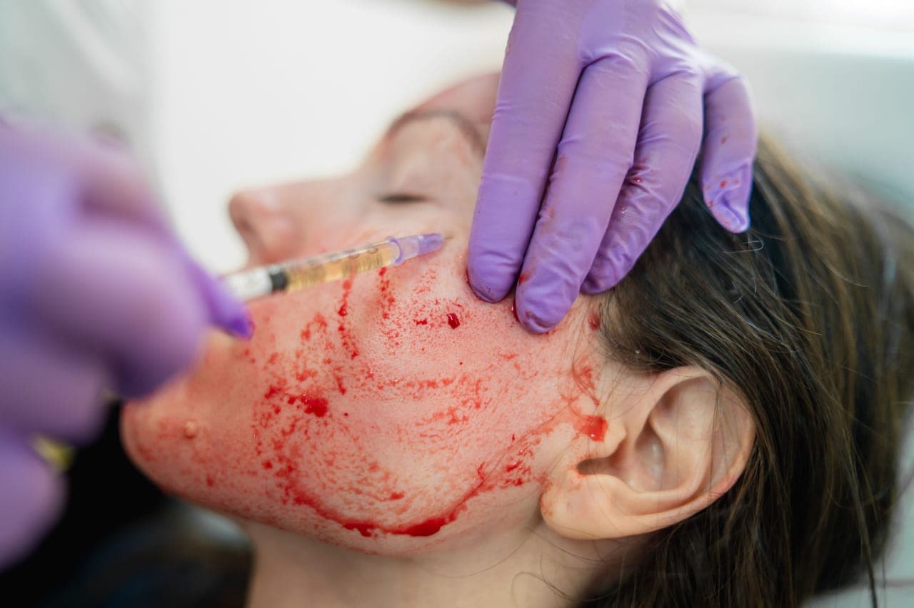Vampire Facial Treatment