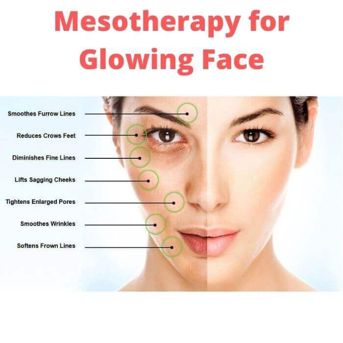 Mesotherapy for Glowing Face