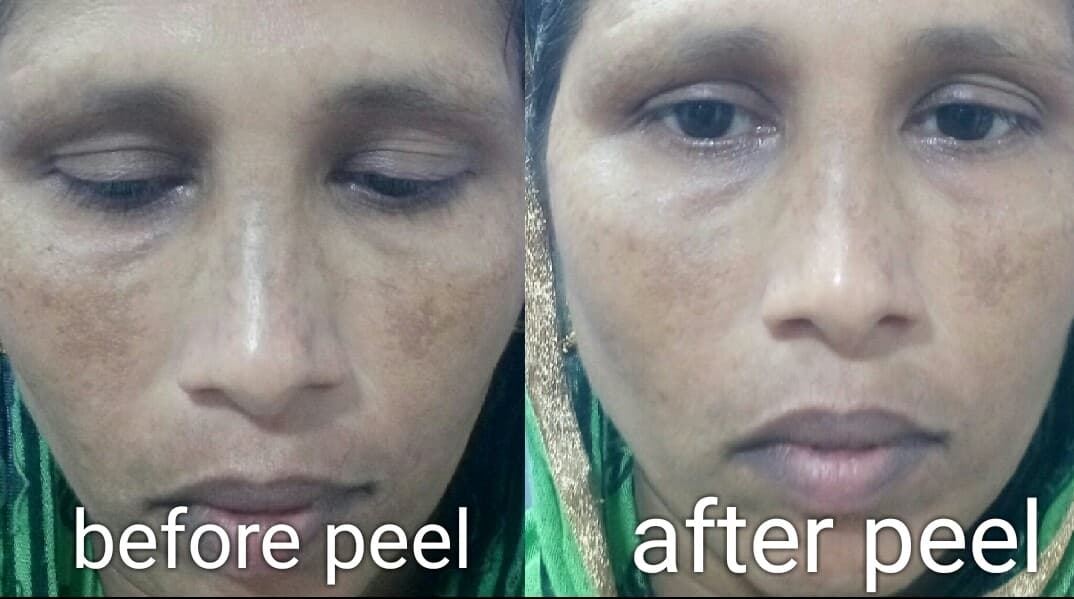 Face Peeling